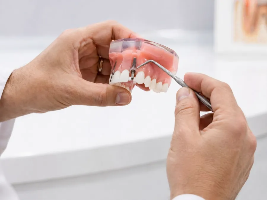 Ilustrasi mimpi gigi copot — Dentist demonstrating dental implant on model