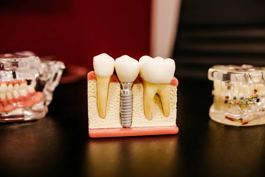 Ilustrasi mimpi pasang gigi — dental implant model with teeth